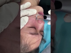 1064nm 532nm Salon Picosecond Maszyna laserowa do leczenia zmian pigmentacyjnych skóry